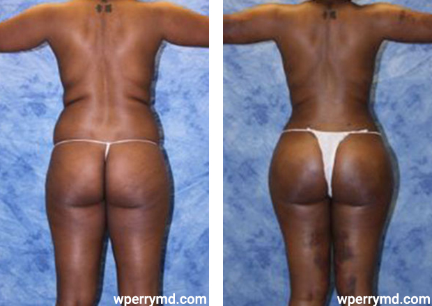 Patient #3957 Brazilian Butt Lift Before and After Photos Pomona