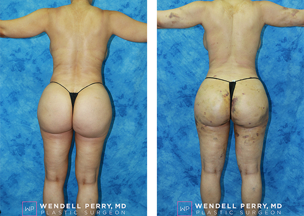 Brazilian Butt Lift Recovery: How To Avoid Sitting After Your BBL — HZ  Plastic Surgery