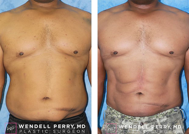 Male Liposuction Gallery