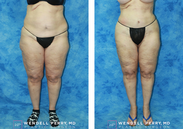liposuction patient